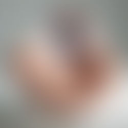 Difference between labelled IOL power and actual power of the IOL