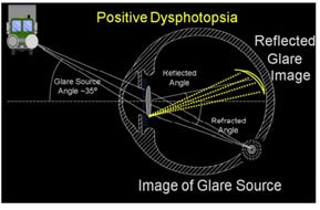 Image source: J Cataract Refract Surg 2012; 38:1251–1265