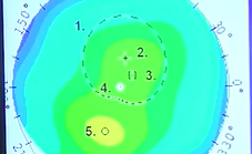 Guide to Pentacam Holladay EKR Report