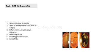Podcast - Posterior Capsular Opacificaion in 5 minutes