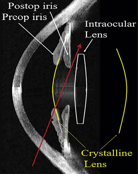 A modified intraocular lens design to reduce negative dysphotopsia Jay C. Erie, MD, Michael J. Simpson, PhD, Mark H. Bandhauer, MS - JCRS 2019