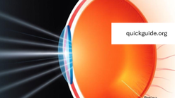 bending of light as light passes through the eye