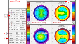 Guide to Pentacam maps