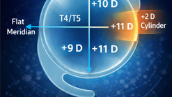 Understanding Toric IOL Power Distribution in Intraocular Lens Optics