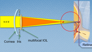 Understanding Defocus Curve of multifocal IOLs