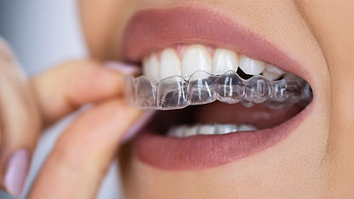 bigstock-Clear-Aligner-Dental-Night-Gua-463488851-1080x675.jpg