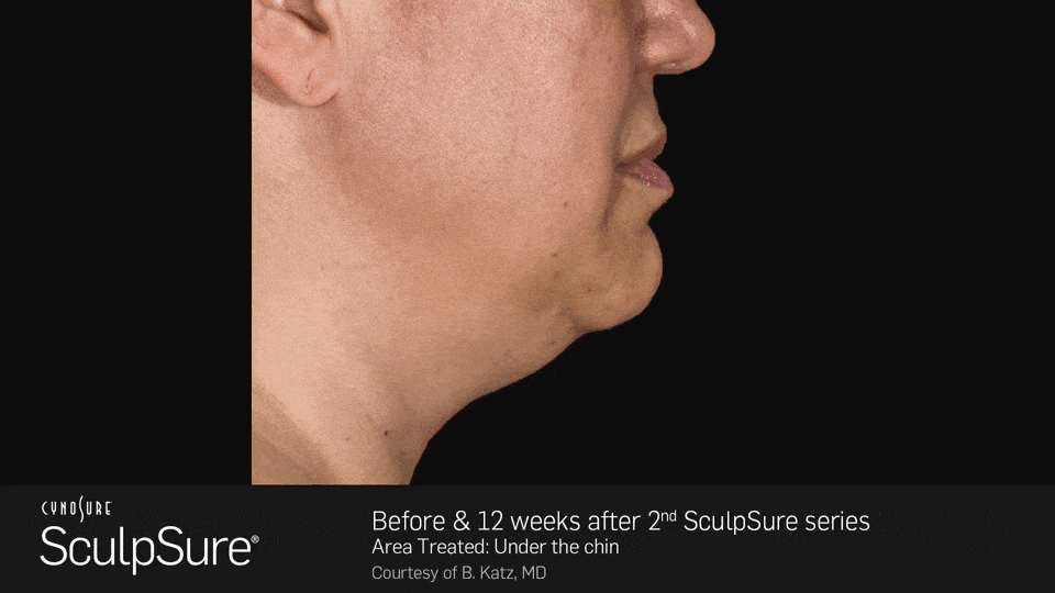 sculpsure chin.gif