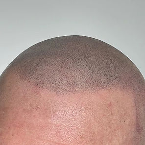 Close-up of a freshly treated scalp displaying a newly defined hairline created through Scalp Micropigmentation (SMP). The pigmentation precisely mimics natural hair follicles, creating the illusion of a fuller, shaved head look. This result demonstrates the advanced technique and artistry used at Hair Ink SMP Gold Coast to restore confidence and deliver natural-looking results for male pattern baldness.