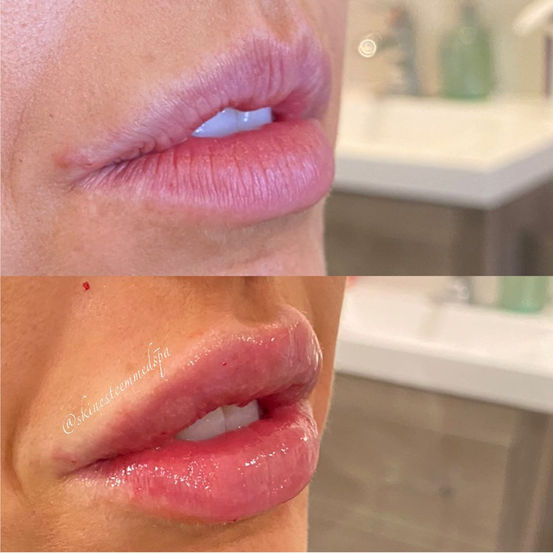 lip-filler-12.jpg