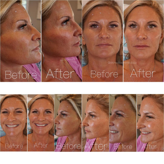 cheek-and-lower-face-filler.jpg