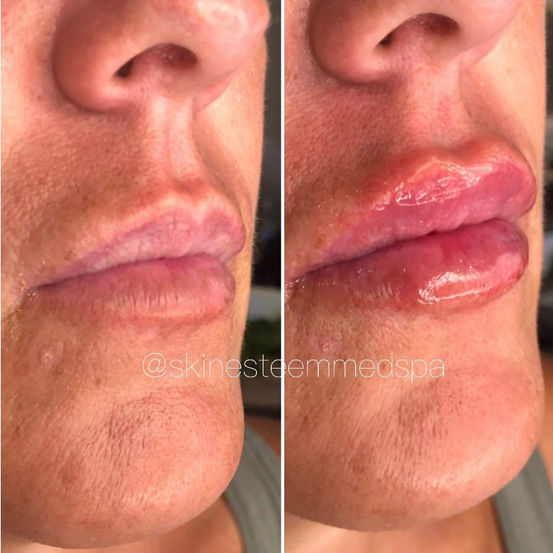 lip-filler-3.jpg