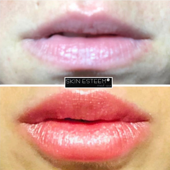 lip-filler.jpg