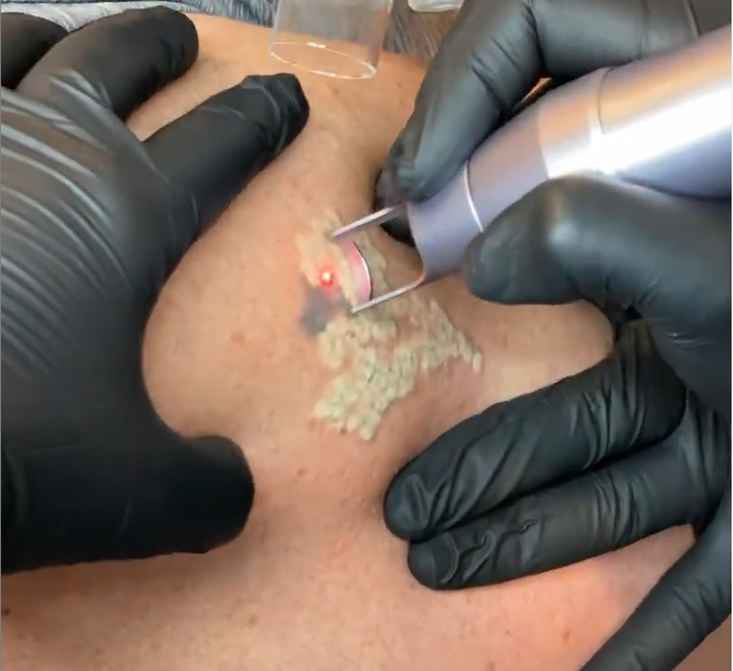 tatto-removal.jpg