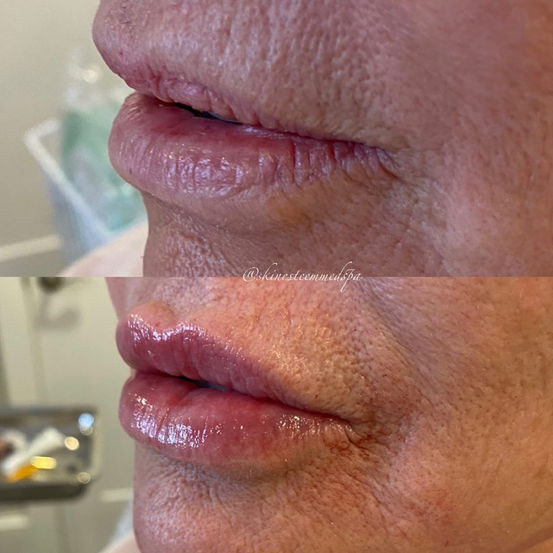 lip-filler-5.jpg