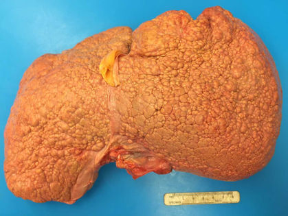 CIRROSIS HEPATICA