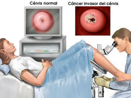CAUSAS DEL CANCÉR DE CÉRVIX