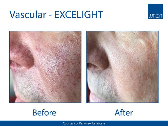 EXCELIGHTBAVascularFacialVessels-650x488