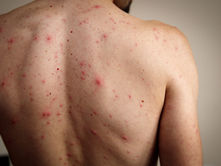 Sarampión: virus puede permanecer hasta una hora en el aire; autoridades refuerzan vacunación