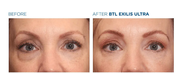 Exilis Ultra 360-1.jpeg