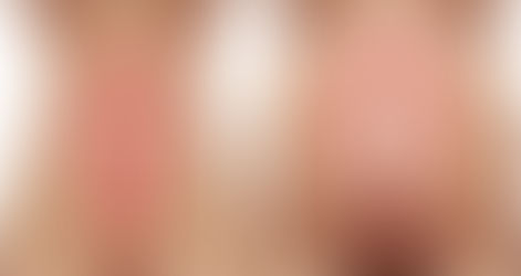 Wat is een diastase en kunnen we dit voorkomen?