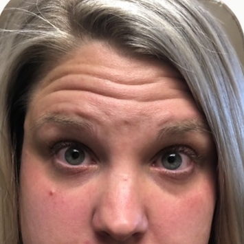 Forehead Wrinkles before picture