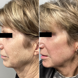 fully ablative CO2 laser resurfacing results