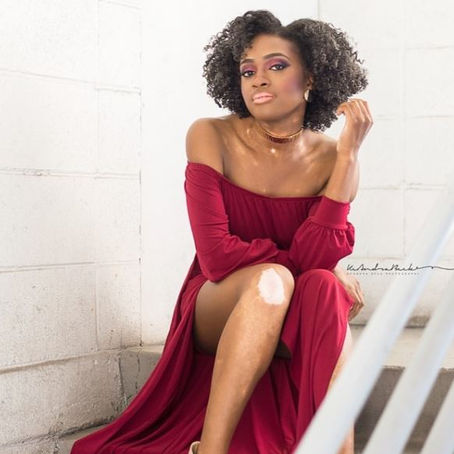 Redefined Beauty: Vitiligo Is NOT a Curse!