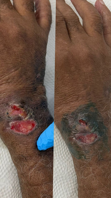 Antes e depois da aplicação de laser terapêutico com dosimetria correta mostrando melhora da qualidade da cicatrização do tecido
