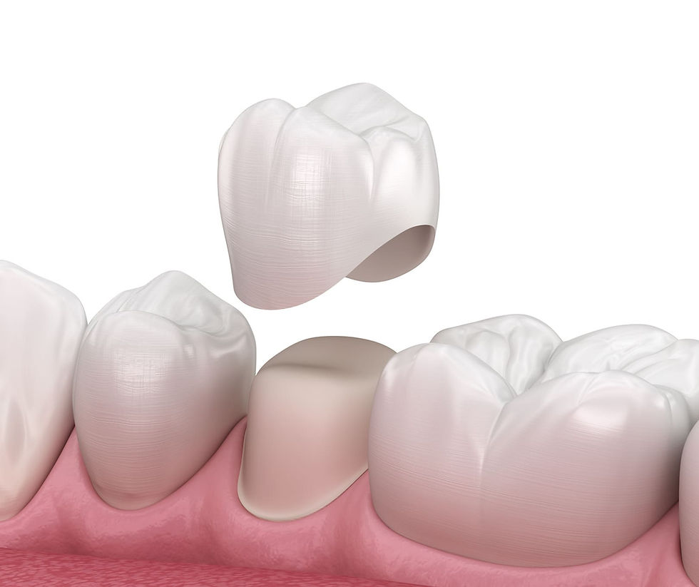  Monolithic vs. Layered Crowns: Which One is Right for You?