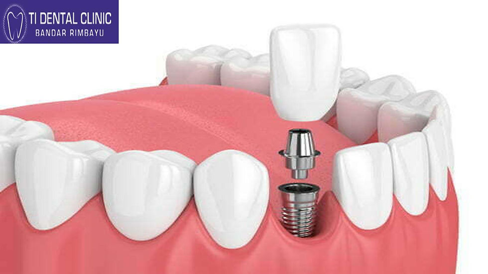 Understanding the Cost of Dental Implants: What You Need to Know
