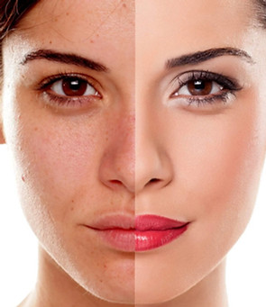 Anti Age Chemical Peel _edited.jpg