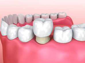 How a Dental Crown Restores a Tooth, From Your Family & General Dentist in McKinney, Texas