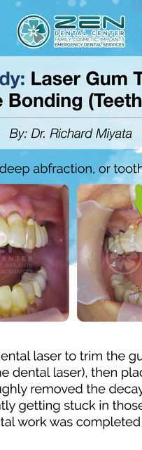 Family Cosmetic Implants Capitol Hill Seattle Wa Zen Dental