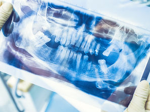 McKinney, TX Residents Ask: What Are the Consequences of Missing Teeth? | CK Dental City