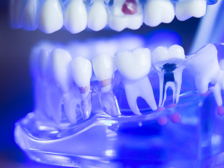 How To Tell When You Need A Root Canal, Explained By Your General Dentist in Salem, Oregon