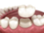 CK Dental City of McKinney TX 75070 Emergency, Invisalign, Family, Cosmetic - Dental Implants, Dental Checkup, Cleaning & Examinations, Crowns, Bridges, Restorations, Veneers, Tooth Extraction, Dentures, Partial Dentures, Teeth Whitening, Emergency Dentist, Invisalign Dentist, Kid Friendly Dentist, Periodontics, Root Canal Therapy
