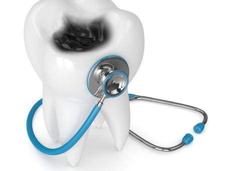 All About Cavities! Your General and Emergency Dentist in Beaverton, Oregon Explains
