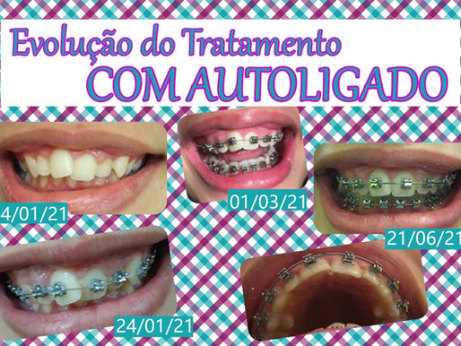 Como fazer seu Tratamento Ortodôntico Mais Rápido ? COM APARELHO AUTOLIGADO . Verdade ou Mito ?