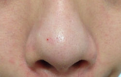 Front of Nose (Before using product)