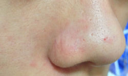 Right of Nose (Before using product)