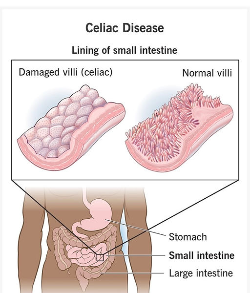 Dr. Noushin Kiahosseini, ND, Naturopathic Medicine - Celiac Disease