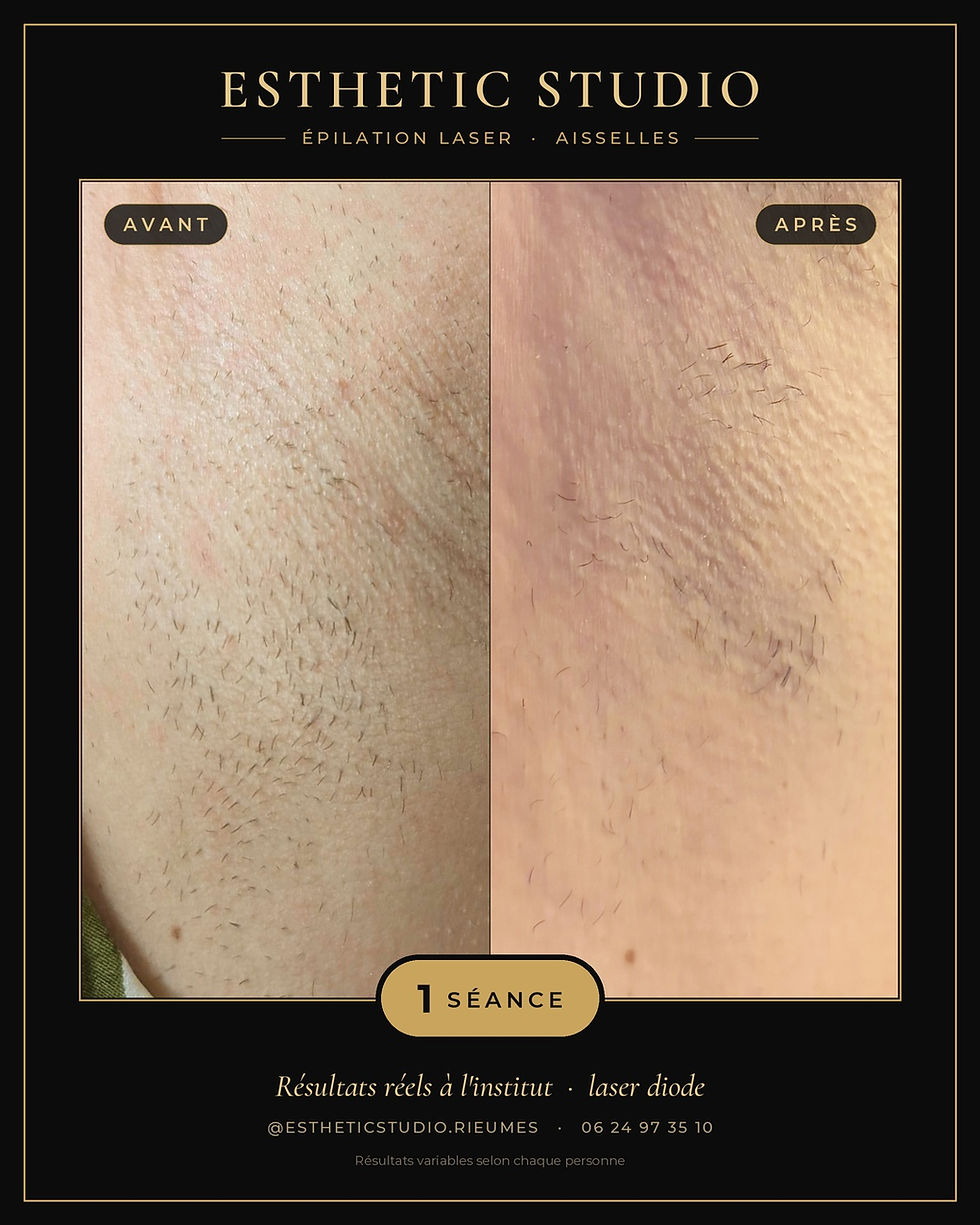 epilation-laser-aisselles-avant-apres-1-seance-rieumes-saint-lys.jpg