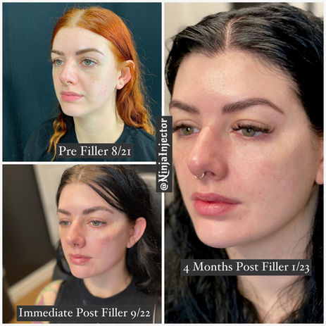 facial balancing  before and after 