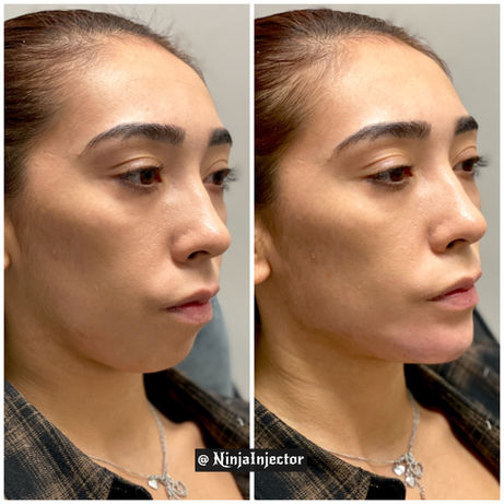 Jawline and chin filler before and after slight right