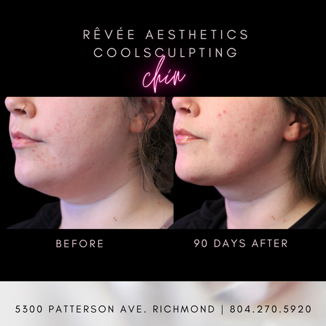 CoolSculpting chin before and after