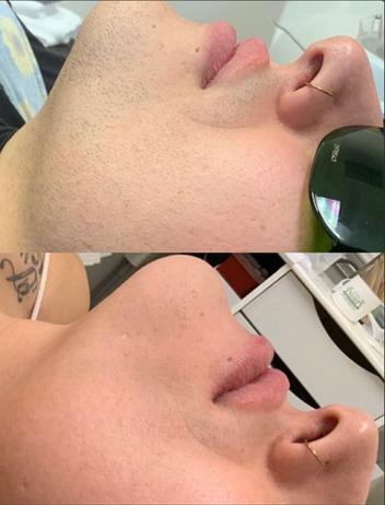 Laser hair removal before and after on the face