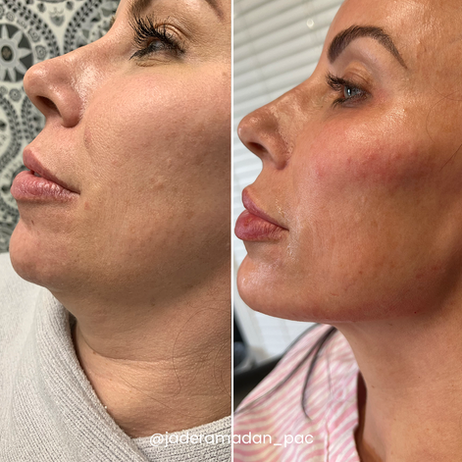 Jade Filler cheeks lips chin and jawline Before and After