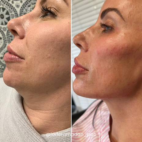 Jade Filler cheeks lips chin and jawline Before and After