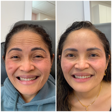 Botox before and after by Becca
