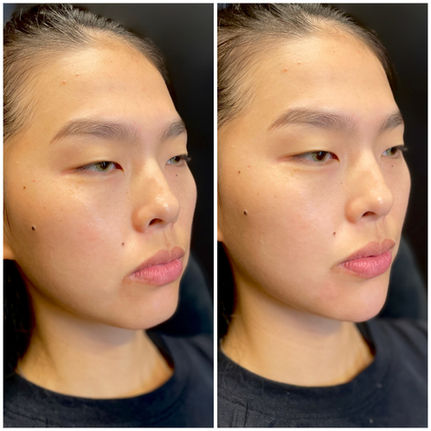 chin filler